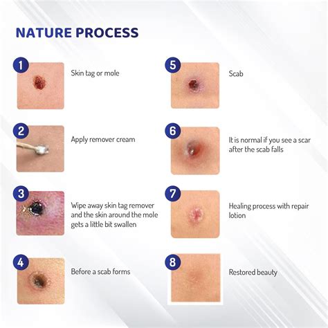 Mole Removal & Skin Tag Repair Gel Set - Remove Effectively at Home