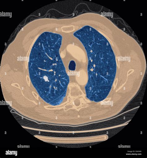 LUNG CANCER, SCAN Stock Photo - Alamy