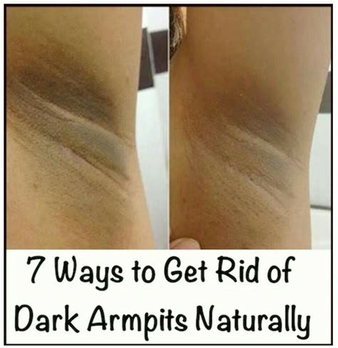 Get Rid Of Dark Underarms With These Natural Solutions Alldaychic