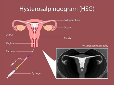 Hysterosalpingogram Hsg Test What To Expect And Results Rma Fertility