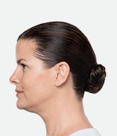 Say Goodbye To Double Chin Effective Solutions For Removal