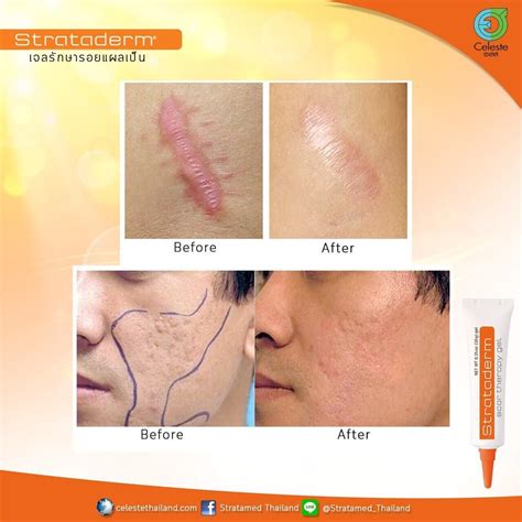 Strataderm