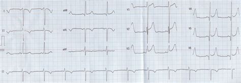 Recording A Good Ecg ജോൺസൺ ഫ്രാൻസിസ് എം ബി ബി എസ്സ് എം ഡി ഡി എം