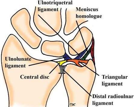 Triangular Fibrocartilage Complex Tfcc Injury Hand Off