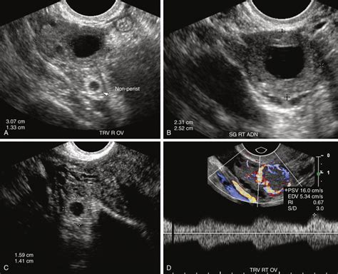 Ectopic Pregnancy Radiology Key