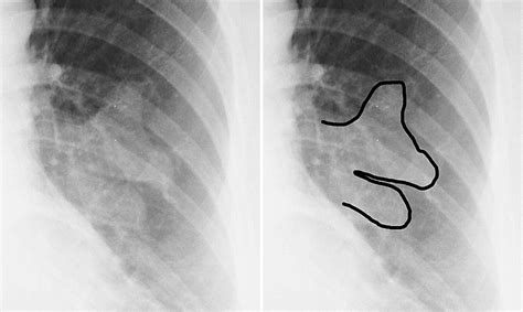 Mucoid Impactions Finger In Glove Sign And Other Ct And Radiographic