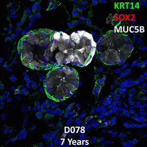 Year Old Human Lung With Asthma Immunofluorescence And Confocal