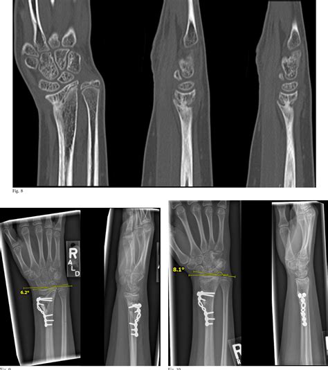 Figure From Corrective Osteotomy And Physeal Bar Resection For Distal