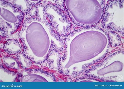 Benign Prostatic Hyperplasia Light Micrograph Stock Image Image Of