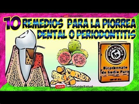 Remedios Caseros Para La Piorrea Dental O Periodontitis Como