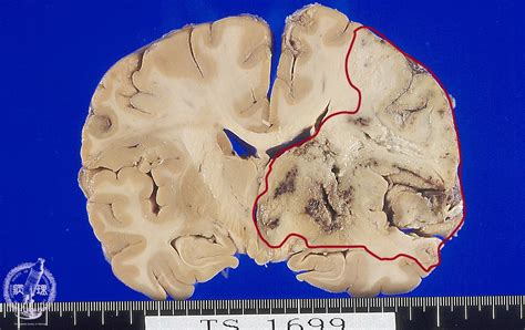 17 Nervous System 2 Cerebral Infarction Pathology Core Pictures