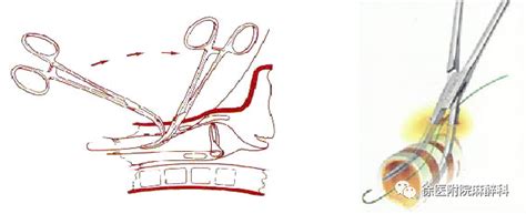 经皮气管切开术，麻醉医生的又一法宝！切开术并发症扩张器气管麻醉导丝套管导管颈部气切病人 健康界