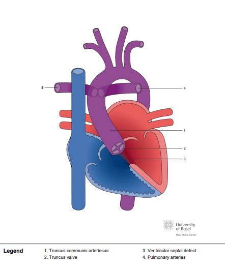 Truncus Communis Arteriosus Type Ii Perfusfind