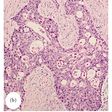 Mucoepidermoid Carcinoma With Dedifferentiation To Undifferentiated Download Scientific Diagram