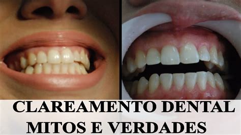 CLAREAMENTO DENTAL A Dr Fabi Duvidas Sobre O Procedimento No