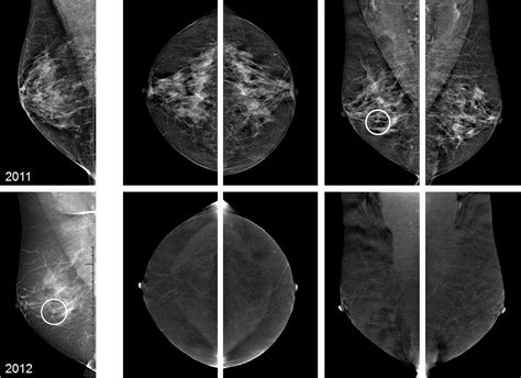 Contrast Enhanced Mammography Techniques Current Results And