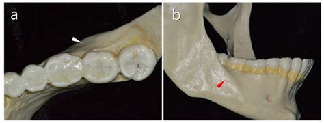 Medicina Free Full Text An Update On Endodontic Microsurgery Of