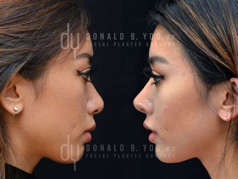 Nose Job Before And After Asian Women