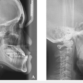 Demonstration Of Cephalometric Pharyngeal Evaluation To Illustrate Each