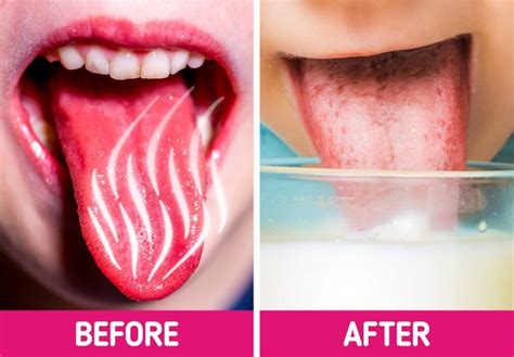 Ways To Heal A Burnt Tongue After Eating Hot Food Artofit