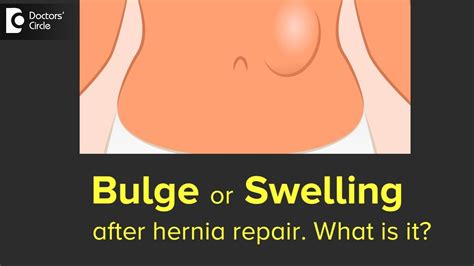 Why Does The Bulge Remain After Hernia Repair Dr Nanda Rajaneesh