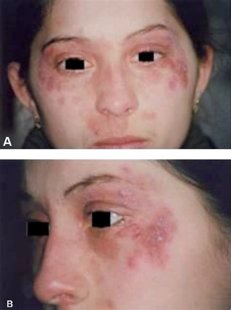 A Case Of Tinea Incognito Diagnosed Coincidentally Semantic Scholar