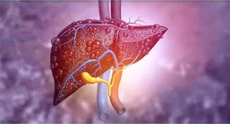 Today Health Tips Get Rid Of Your Fatty Liver As It Can Lead To Cancer