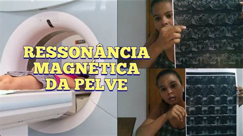 RessonÂncia MagnÉtica Da Pelve Minha ExperiÊncia Vida De Tentante