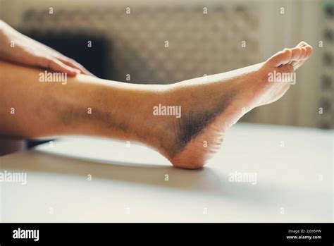 Swelling Leg Hi Res Stock Photography And Images Alamy