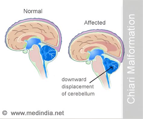 Chiari Malformation Types