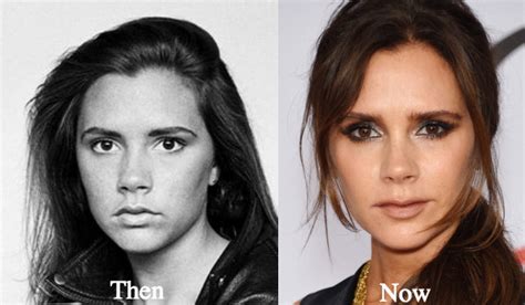 Victoria Beckham Plastic Surgery Before and After Photos