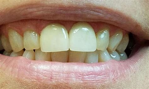 Kingwood Wv Dentist Before After Photos