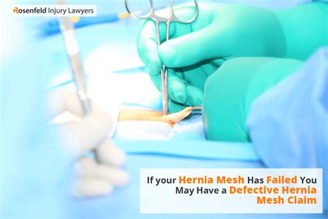 Hernia Mesh Lawsuit Claim Settlement Info Updates