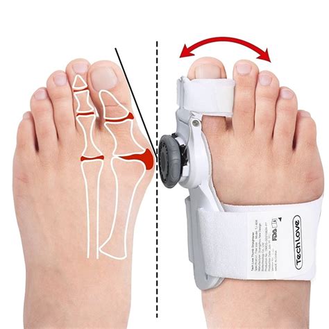 Upgraded Bunion Corrector 3d Knob Toe Corrector Vernier Store