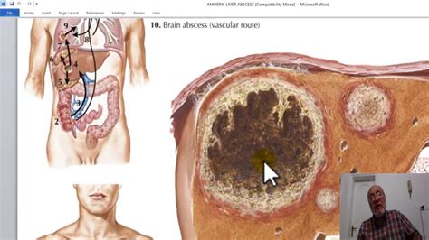 Hepatic Surgery 12 Amoebic Liver Abscess By Dr Wahdan Youtube