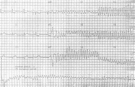 Ventricular Fibrillation (VF) • LITFL • ECG Library Diagnosis