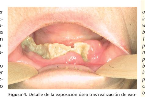 Figure From Osteonecrosis De Los Maxilares Asociada Al Empleo De