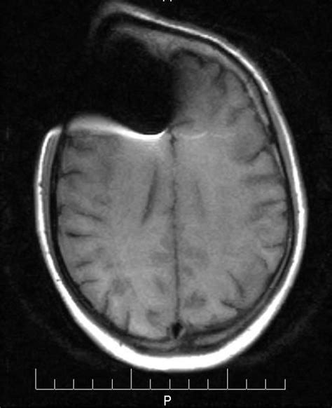 Magnetic Susceptibility Artifact Radiology Reference Article