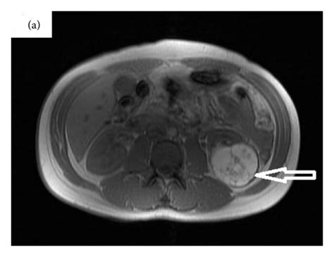 A T1 Weighted Mri In Axial Section Showing Left Renal Mass With