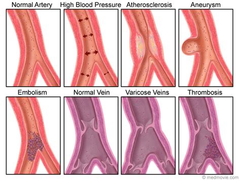 Carotid Endarterectomy Treating Carotid Artery Disease Artofit