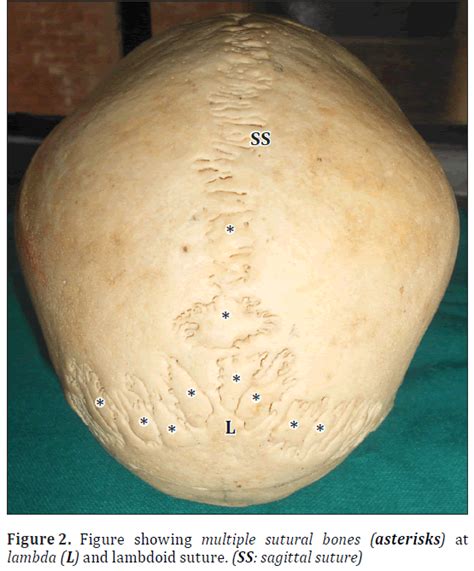 Human skull with complete metopic suture and multiple sutural bones at ...