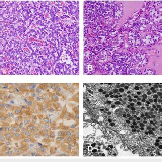 Pathological Analysis Of The Resected Tumor Microscopic Evaluation