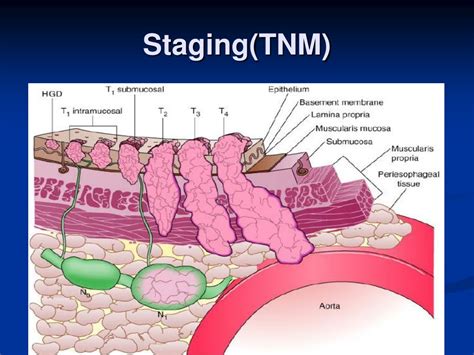 Esophageal Tnm Staging