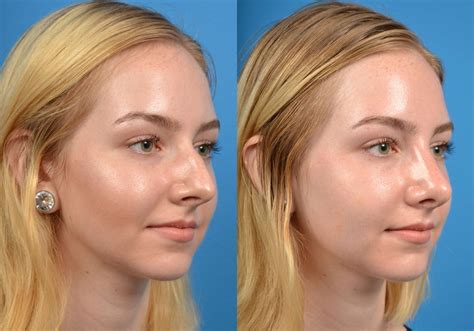 Patient 122406563 Rhinoplasty Before And After Photos Clevens Face And Body Specialists