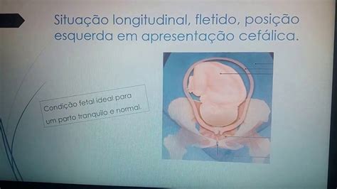 Feto Unico Em Situação Longitudinal - Feto Em Casos De Feto