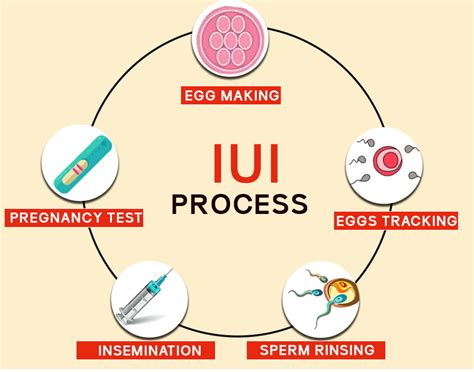 Intrauterine Insemination Iui Dr Shruti Sthapak