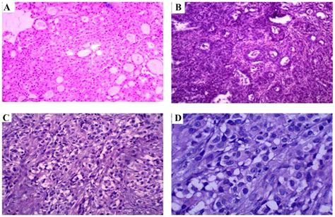 Malignant Mesothelioma Of The Tunica Vaginalis Testis A Case Report And Literature Review