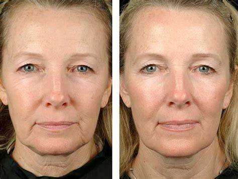 Thermage Reviews New York Thermage Skin Tightening New York