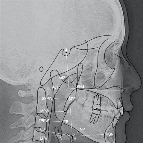 Cephalometric Landmarks And Measurements Of Pharyngeal Airway