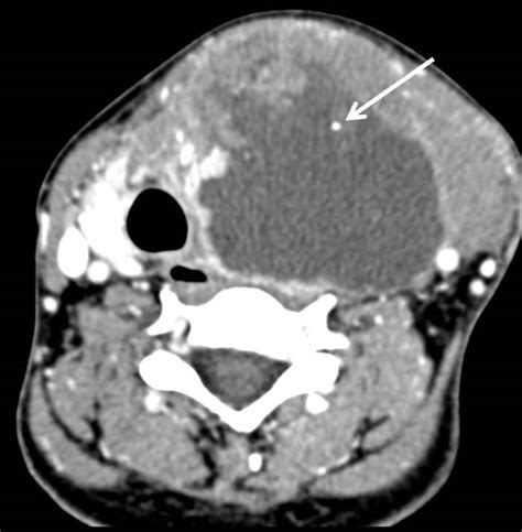 Anaplastic Thyroid Carcinoma Radiology Cases